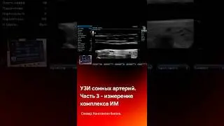 УЗИ сонных артерий. Часть 3 - измерение комплекса интима-медиа 