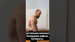 Сагиттальная плоскость. Уплощение кифоза. Сутулость