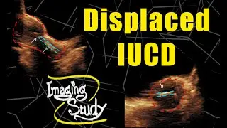 Displaced Intrauterine Contraceptive Device - Copper-T || Ultrasound || Case 113