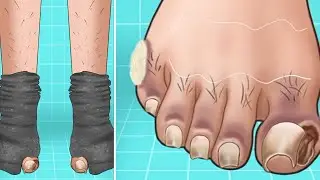 ASMR | Perawatan Kuku Yang Terkelupas | Foot Care