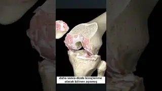 Diz Protezi Ameliyatını Nasıl Yapıyoruz? 