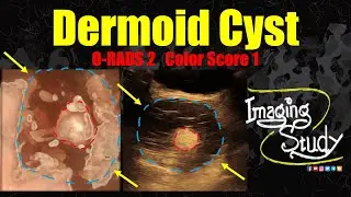 Adnexal Dermoid Cyst | Mature Cystic Teratoma | ORADS 2 || Ultrasound || Case 347