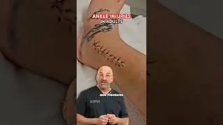Ankle Fracture 🚫 Not Just the Young 