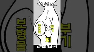 [200만]가슴수술한 사람은 다 공감할걸? 