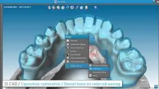 Designing implant bridges