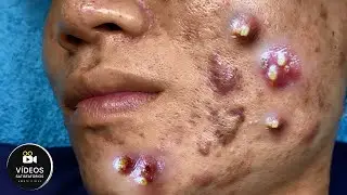 Squeezing Blackheads and Pimples - Very Satisfying 😍
