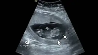 12 weeks, cystic hygroma