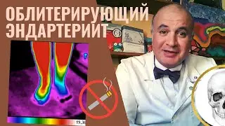 Облитерирующий  ЭНДАРТЕРТЕРИИТ. Синдром 