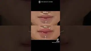 Filler bibir solusi Beauties untuk miliki bibir sexy dan plumpy!✨