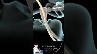Intubation - EndoTracheal Tube - Breathing Tube 