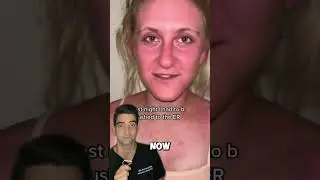 Allergic Reaction