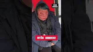 АЛЕРГИЯ НА АЛКОГОЛЬ 