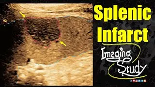 Splenic Infarct || Ultrasound || Case 343