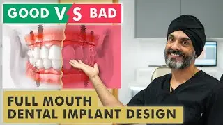 Bad Full Mouth Dental Implant Design vs Good Design - Long Term Effects