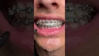 Removing stuff from my braces 🤢