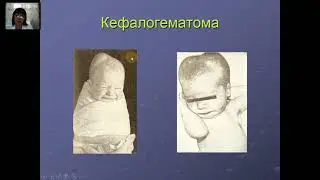 Бош мия тугрук травмалари