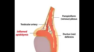 Epididymitis