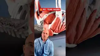 Painful Pectoralis Major Tear⁉️