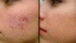 История моей кожи/Как я избавилась от акне