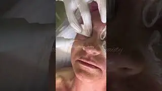 Холодная Плазма | Спектральная фототерапия | Обучение