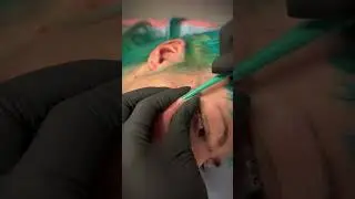 Check This Out! 👀 CHEEK DERMAL 💎 Full process!
