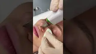 Ультразвуковая чистка лица