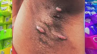 What Causes Large Sebaceous Cysts?