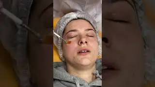 Пилинг VitaPeel Ultraceuticals