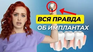 Срок службы зубных имплантов?