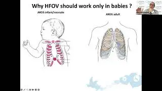 High Frequency Oscillatory Ventilation for Infants in the PICU Understanding When and How