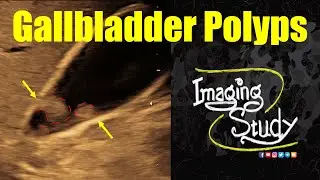 Gallbladder Polyps || Ultrasound || Case 346