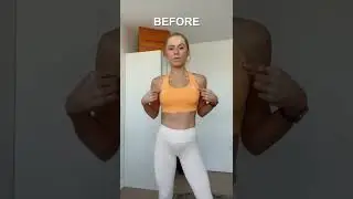 BEFORE & AFTER BREAST IMPLANTS REMOVED 