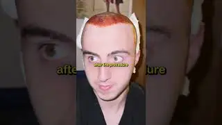 I Got a Hair Transplant... 3 Week Transformation