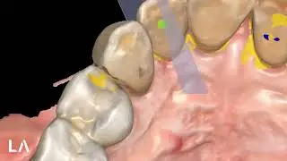 Reductive Wax-Up in EXOCAD with SMILE CREATOR