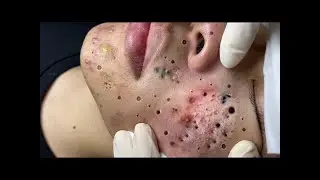 Skin cleaning | Giant Carnations | Very Satisfactory 🤗