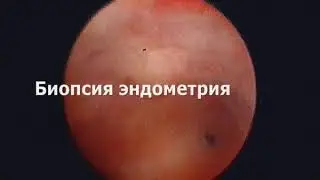 Офисная гистероскопия  Биопсия эндометрия