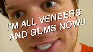 When your bro gets veneers