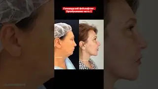 Голливудский фейслифтинг. Пластический хирург Татьяна Романовская