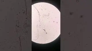 Urinary Tract Infection under the microscope | Pyuria | 