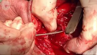 Laryngectomy. Surgical removal of the larynx