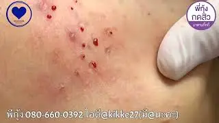 Выдавливание чёрных точек НОВОЕ! Полная чистка лица от чёрных точек. Прыщи - выдавливание и удаление