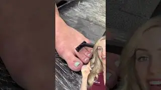 Doctor reacts: rare toe condition