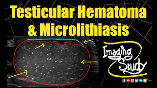 Testicular Hematoma & Microlithiasis || Ultrasound || Case 205