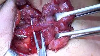 Thyroidectomy