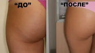 ИЗБАВИТЬСЯ ОТ ЦЕЛЛЮЛИТА ЛЕГКО ДОМА! СОВЕТЫ СПЕЦИАЛИСТОВ!