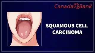 Squamous Cell Carcinoma