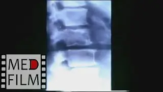 Roentgen of the spine with osteochondrosis ©