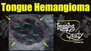 Tongue Hemangioma || Ultrasound | Doppler || Case 351