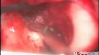 Закрытие фистулы полукружного канала.