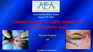 Cataract surgery in myopic and post vitrectomy eyes  Richard Packard MD